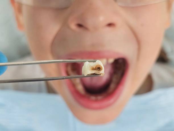 Best Emergency Root Canal Treatment in Aurora, TX